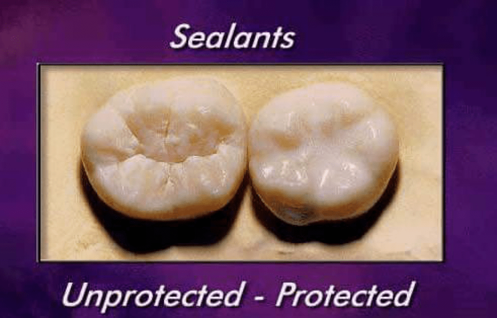 sealants